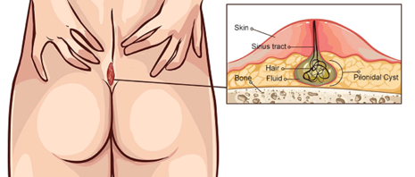 Image showing location at the top of the bottom/base of back. Detail of the cyst- a fleshy bump with a duct containing hair and fluid under the bump. The sinus tract, reaching the surface of the bump, is marked.