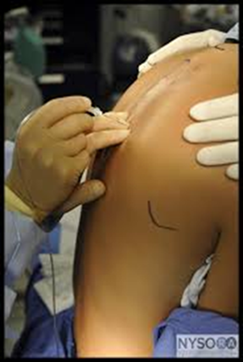 Photo of a persons torso with a procedure about to be carried out on their back which has been marked with a pen